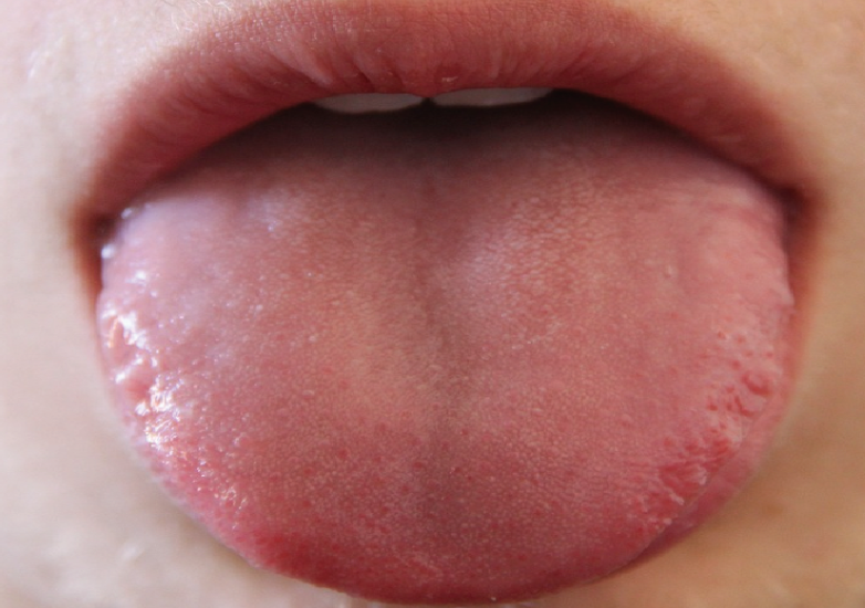 혓바늘이 생긴 혀