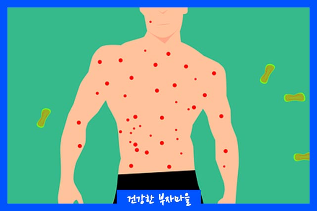 원숭이두창 증상