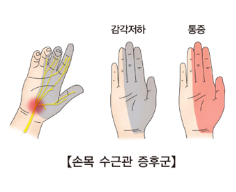 수근관 증후군
