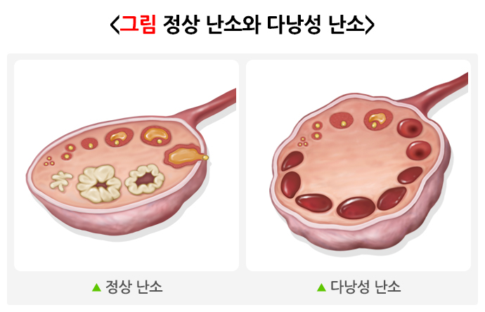 이노시톨