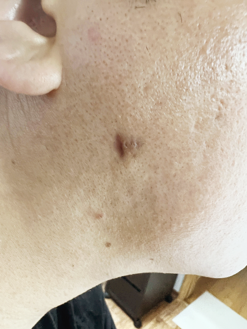 종기치료 4주차