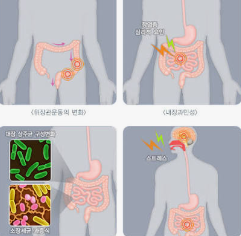 과민성대장증후군