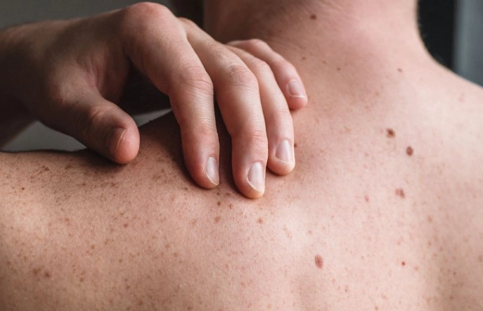 흑색종 피부암 초기 및 증상