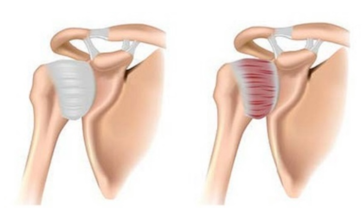 정상 관절과 오십견 관절