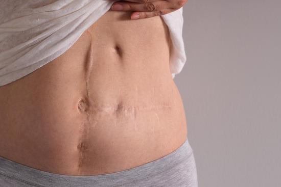 복부 외상 수술: 정의, 과정 및 중요성