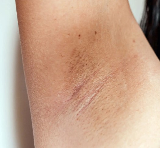 겨드랑이 색소 침착