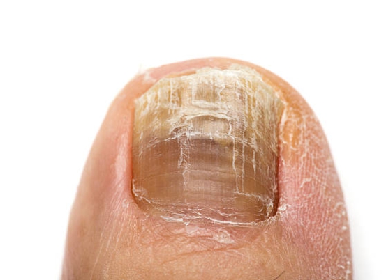 발톱무좀이 있는 발가락