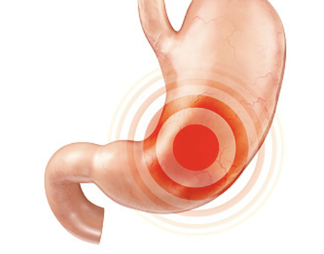 십이지장 궤양 증상 4
