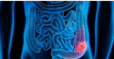 라미나지액 주의사항