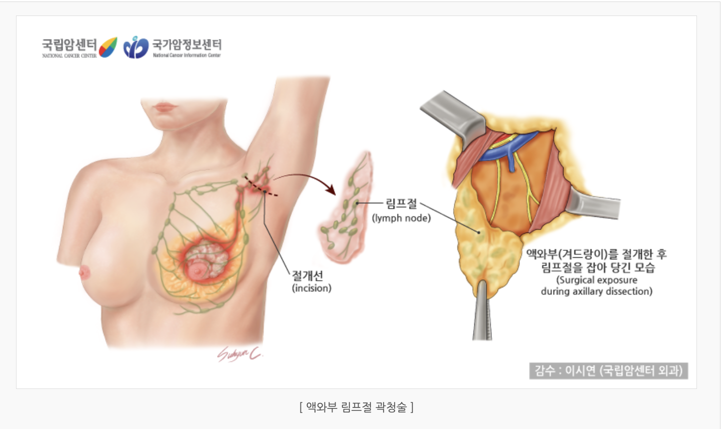 액와부 림프절 곽청술