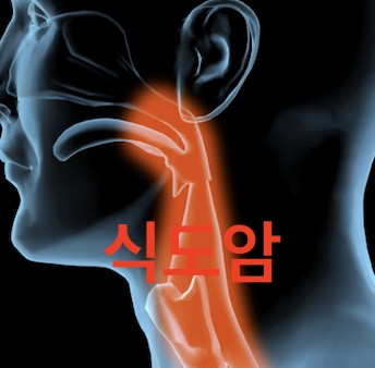 식도암