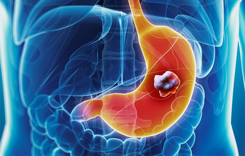 위에 종양이 있는 일러스트
