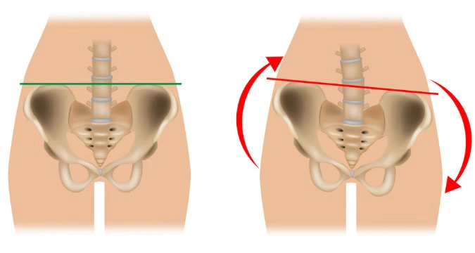 골반 비대칭 틀어짐 증상 6가지 및 골반 라인 교정 방법 영상 Tip