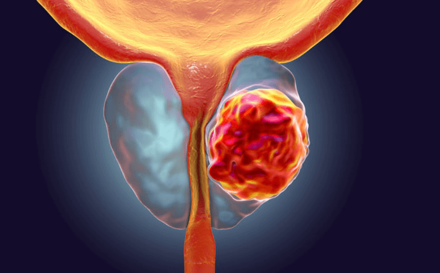 전립선암 증상 원인 염증