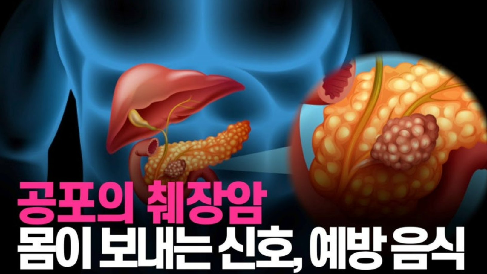 췌장암
