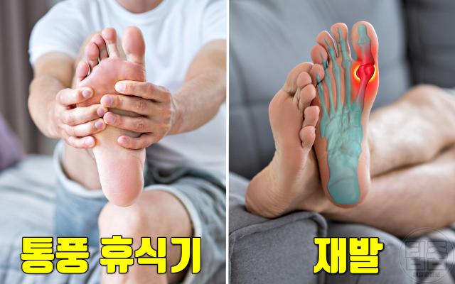 발이 보내는 위험한 신호 통풍 엄지발가락 통풍