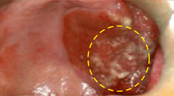 구강암 증상과 원인, 조기 발견이 생명을 살린다
