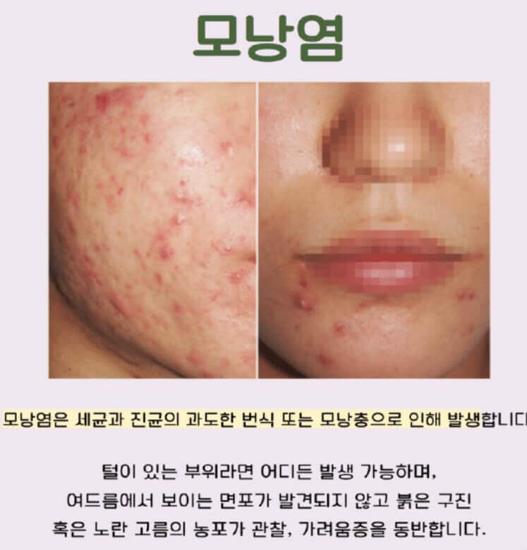 모낭염