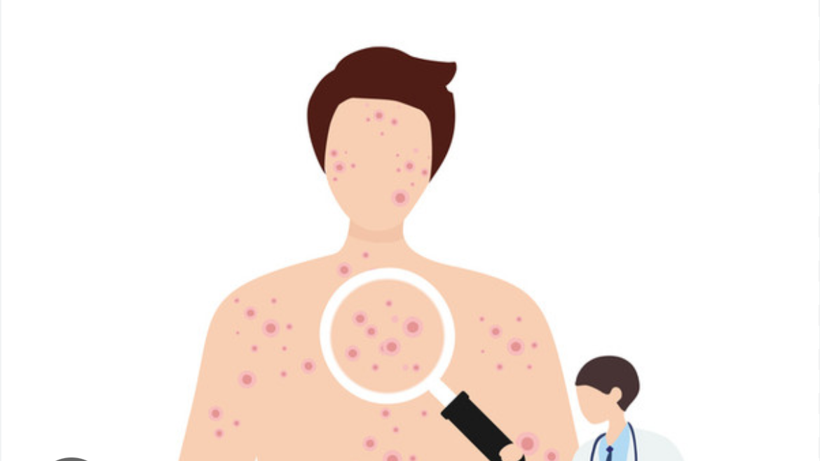 엠폭스-발생국가-발생원인