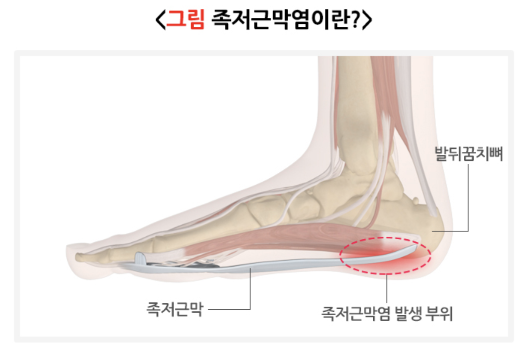 족저근막염이란?