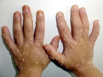 수족구병 증상과 예방 조치 방법 모음_12