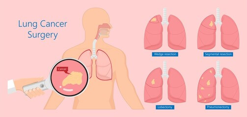 폐결절 원인 및 증상을 알아봤습니다. 폐결절이라는 말은 좀 생소한데요. 물론 폐결절 모두가 암으로 변하진 않지만 마땅한 전조증상이 없기 때문에 더욱 질병에 대해 숙지해야 합니다.