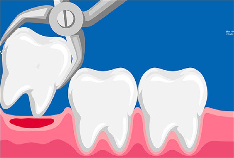 설사랑니 발치명