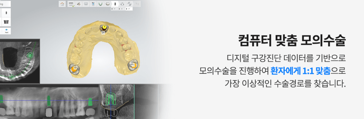 강남플란치과-임플란트가격-비용-시술후기-이벤트