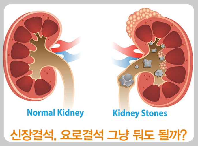 신장결석 증상