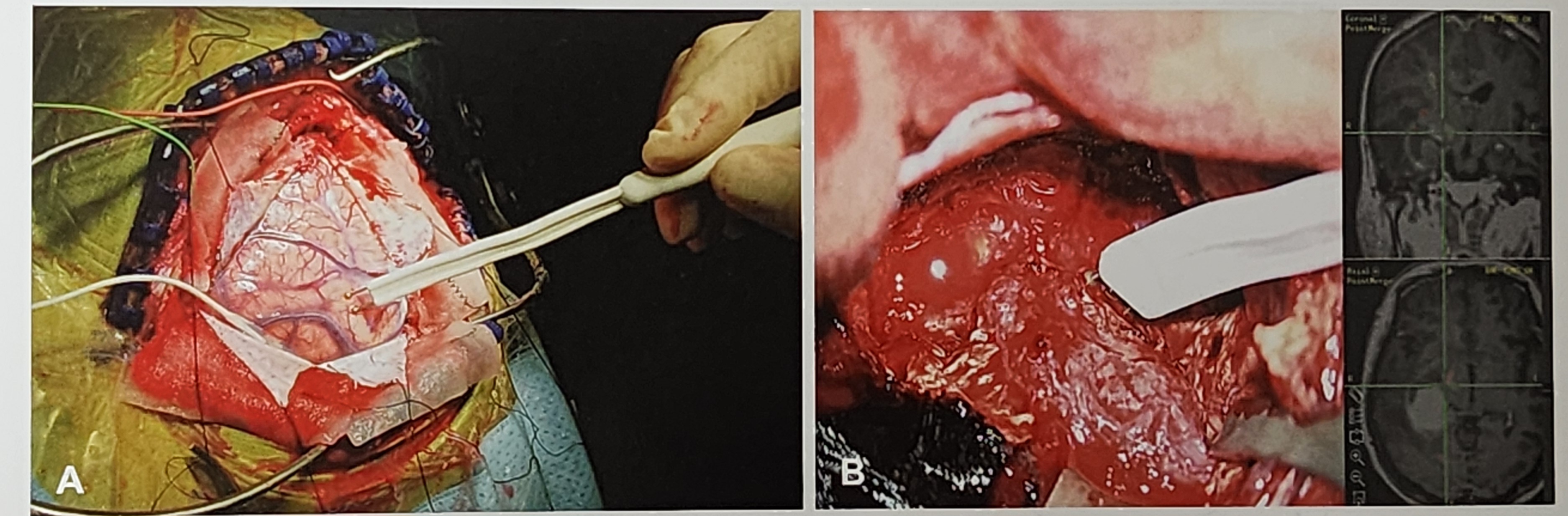 수술 중 뇌지도화의 중요성과 최신 기법 소개