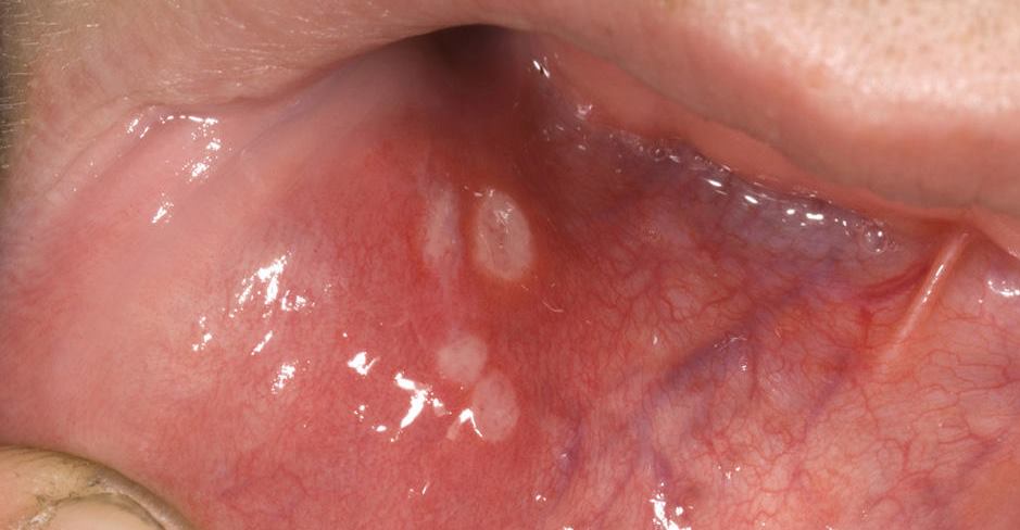 구내염때문에 헐은 입