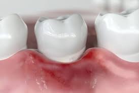 잇몸이 붓고 아플 때