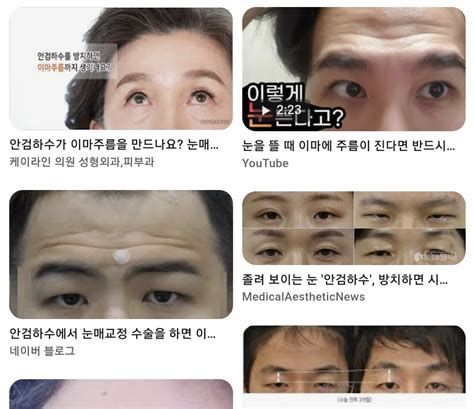 안검하수 비용