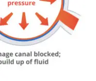 녹내장 초기 증상 &mdash; 시야를 서서히 빼앗는 침묵의 질환
