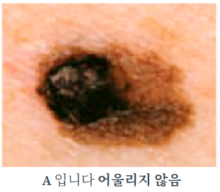 흑색종