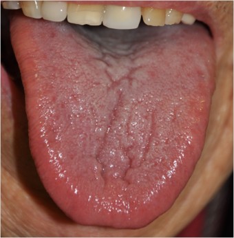 혀 갈라짐 원인