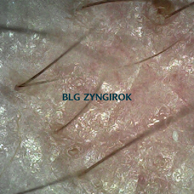 피나모아 복용 23주차 - 오른쪽 M자 부위 두피모습이다.