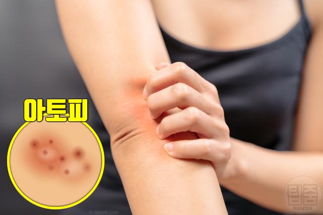 팔꿈치 까만 이유 팔꿈치 가려움