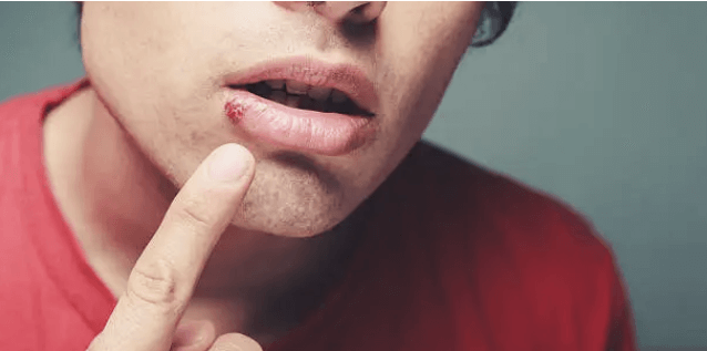 입술포진은 왜 반복될까? 입술포진 증상과 원인, 입술포진 빨리 낫는 법!