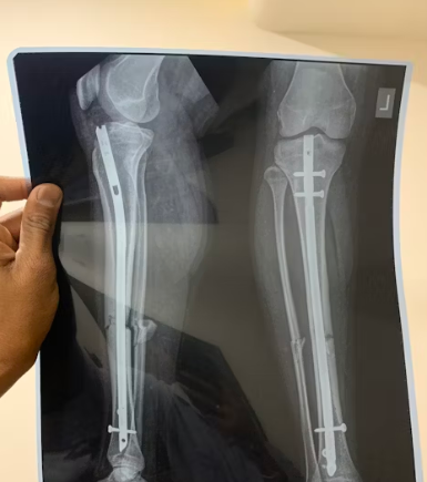 골다공증에 좋은 음식 예방 식단