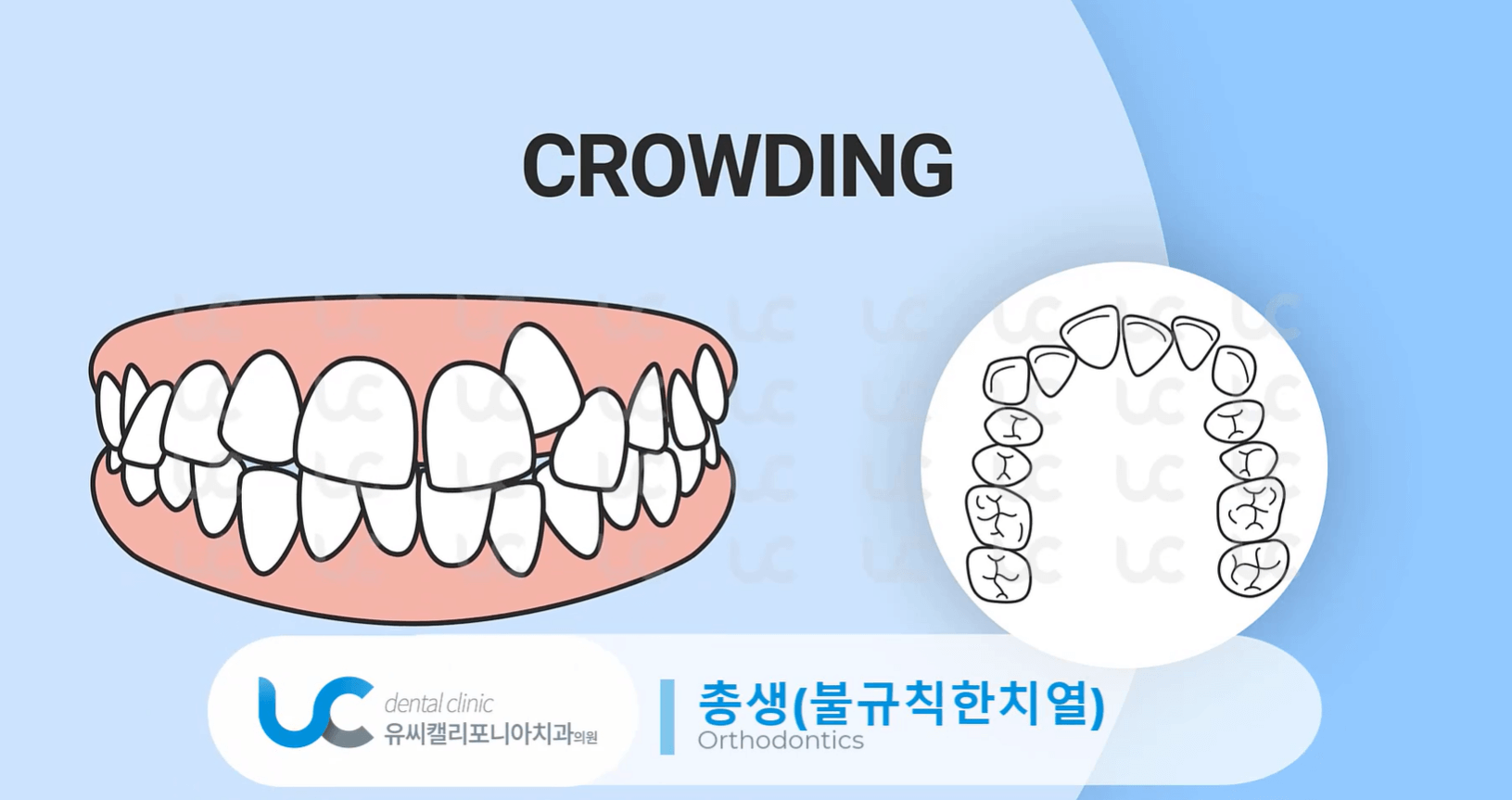 과개교합-치료-안하면
