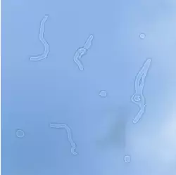 비문증과 파인애플 효과