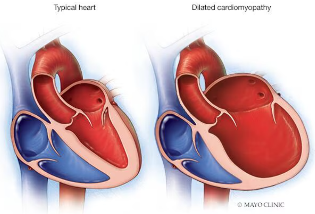 확장성 심장질환 관련 사진
