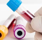 Ferritin 수치