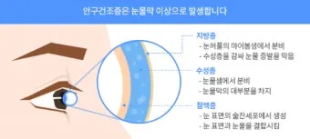 눈물이 자주 나는 이유에 대한 안과정보_15