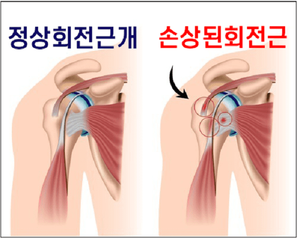 하루 종일 책상 앞에서 일하다 보니 어깨가...."파열 회전근개 복합조직 재건 가능해진다" 포스텍-하버드 의대
