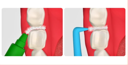 올바른 치간칫솔 사용법을 설명하는 이미지