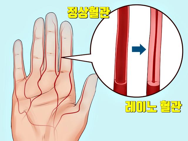 추위 잘 타는 사람 특징 질환 레이노병