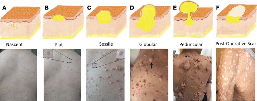 신경섬유종 초기 증상, 혹시 나도? 놓치면 안 되는 신호