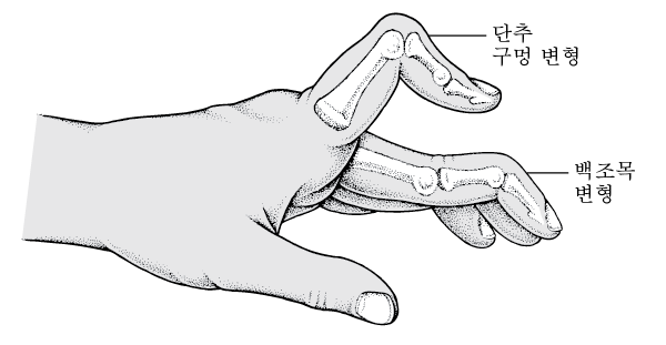 손가락 류마티스 관절염 주요 증상과 체크 리스트